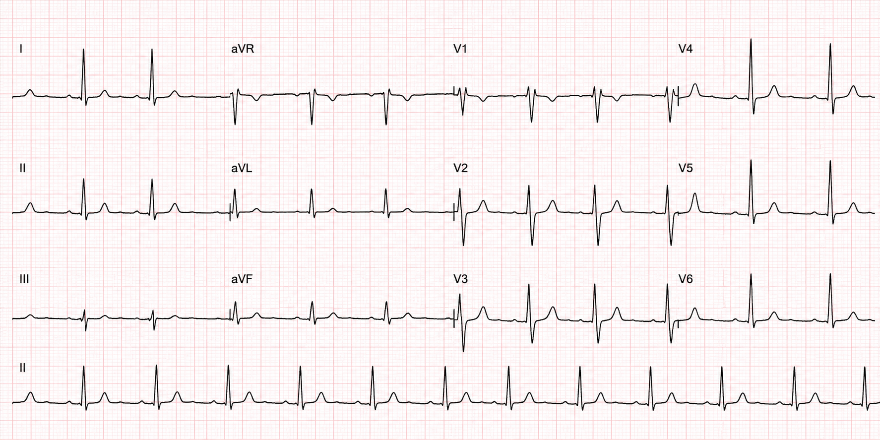 Électrocardiogramme (ECG) montrant les tracés des dérivations I, II, III et les dérivations précordiales V1 à V6 sur fond de papier millimétré.